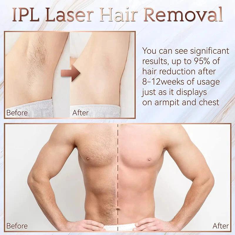 IPL Laser Epilator – Painless Hair Removal Device